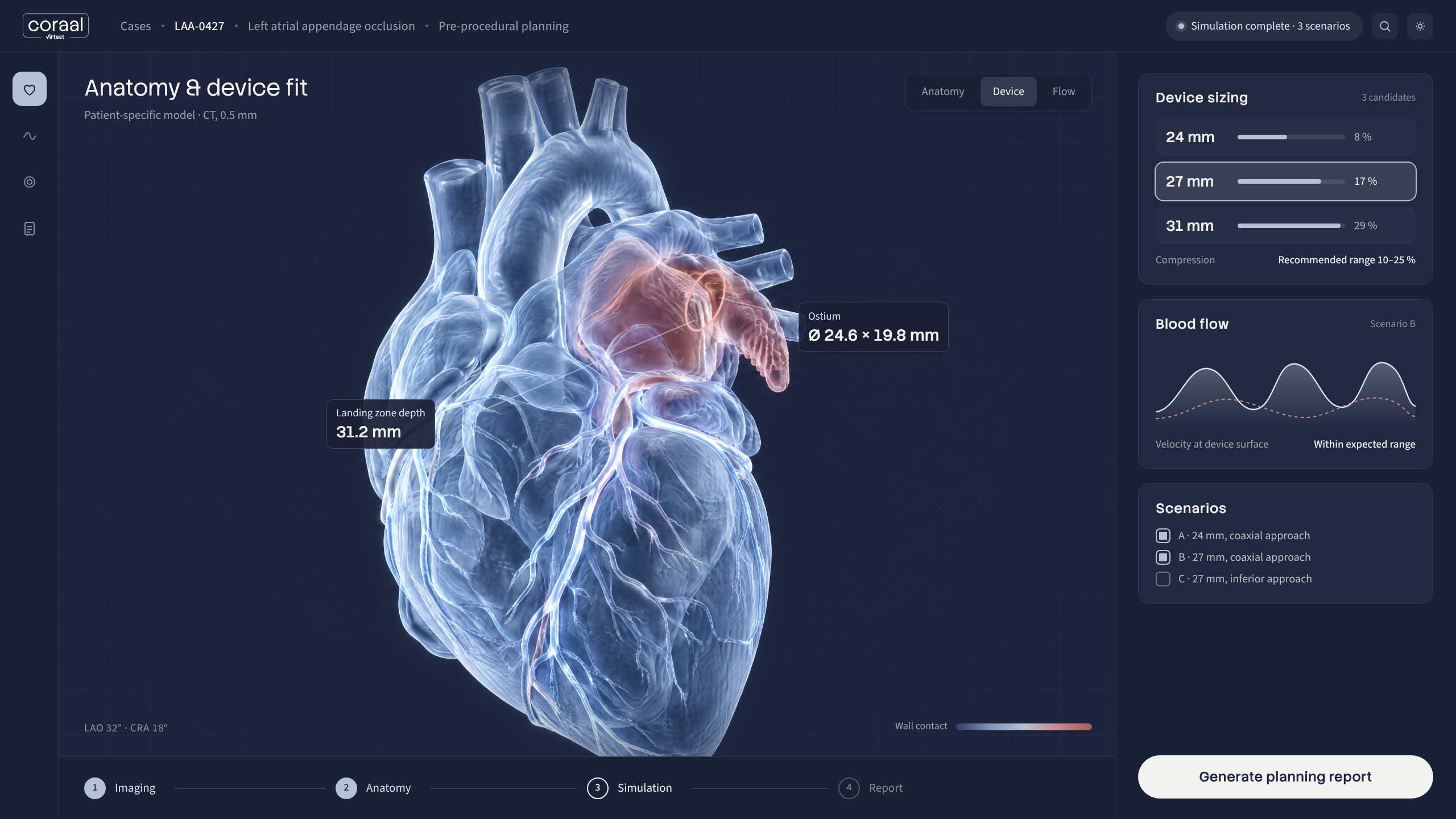Recreación de una pantalla de Coraal: el modelo del corazón del paciente, el ajuste del dispositivo y los escenarios simulados